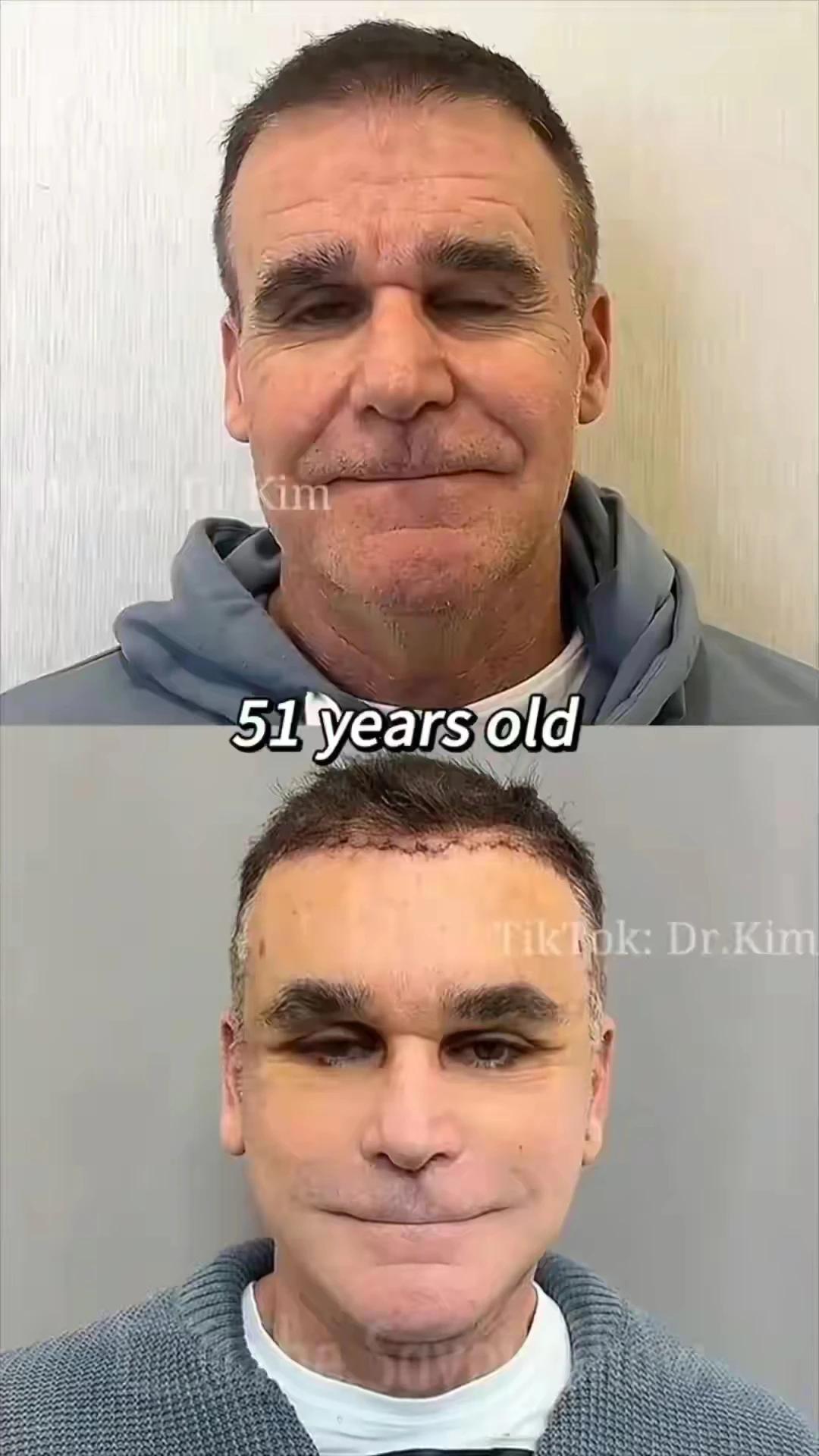 老外做拉皮，正宗的歪果仁。怎么还是觉得老了的那张照片更自然也更好看些呢。
#你一