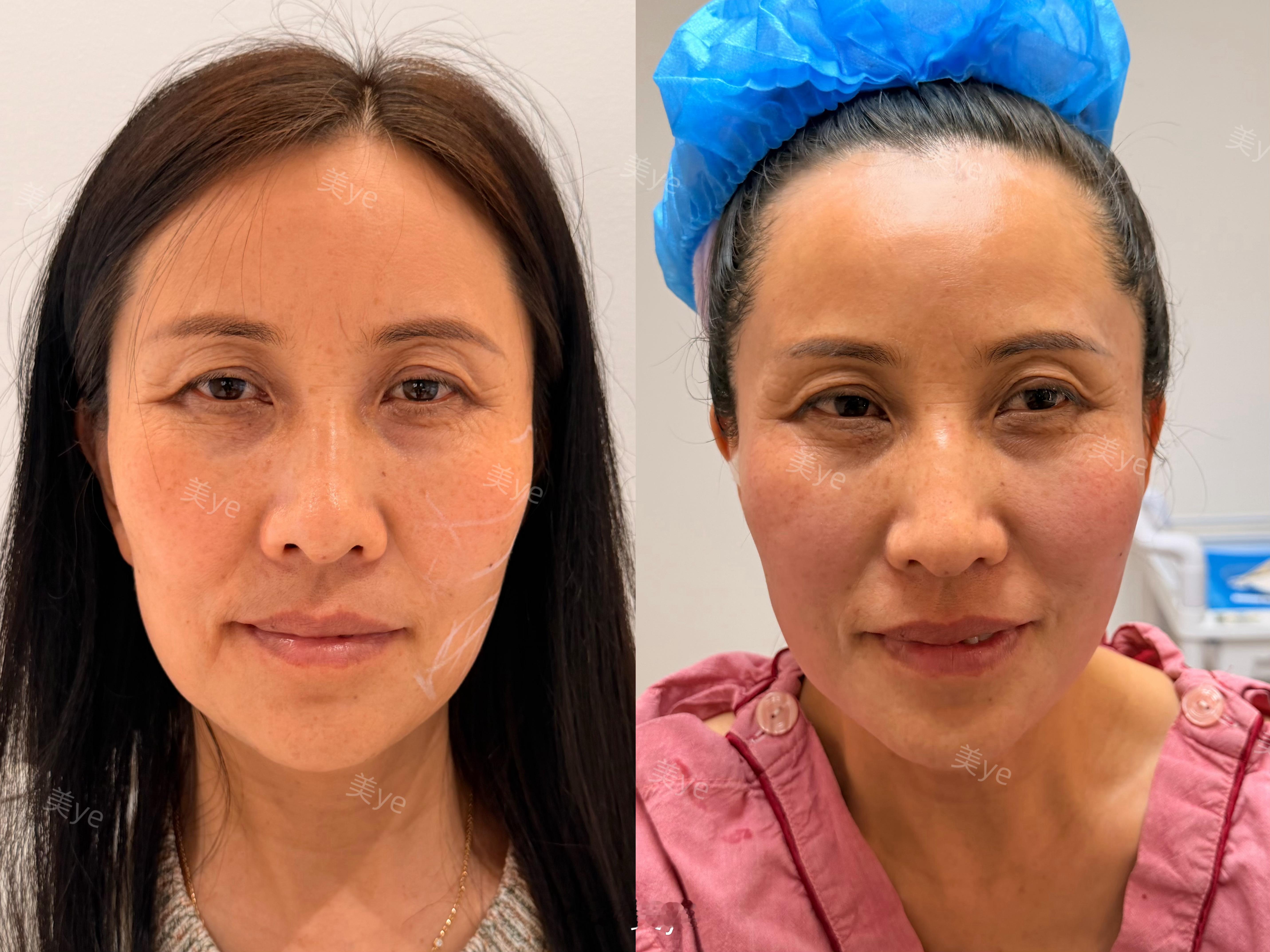不知道为什么会有人觉得光电没效果带我妈在深圳合作机构找院长打的热超联合热玛吉五代