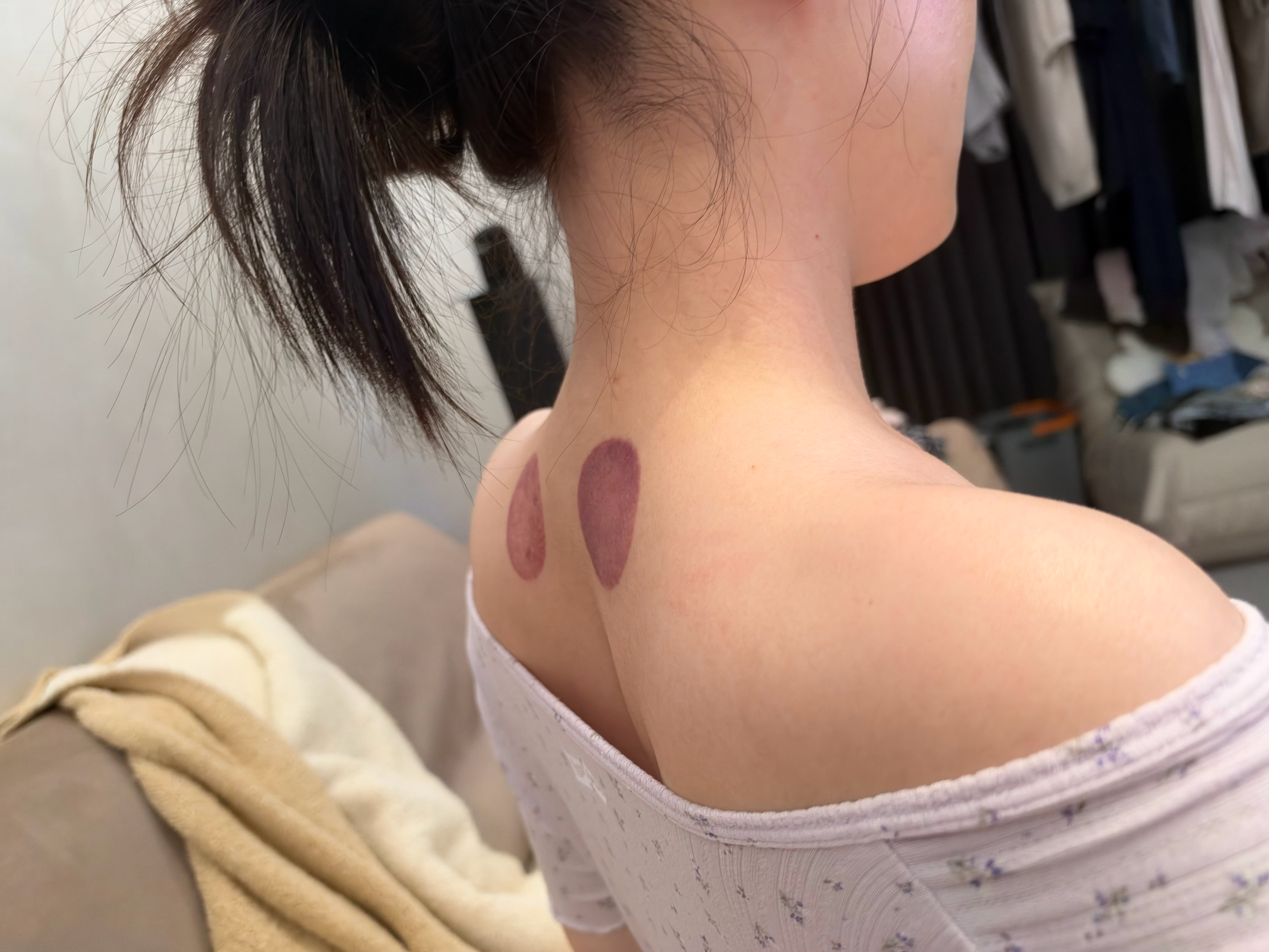 我这是湿毒！！！！拔罐30秒就紫了我晕 ​​​