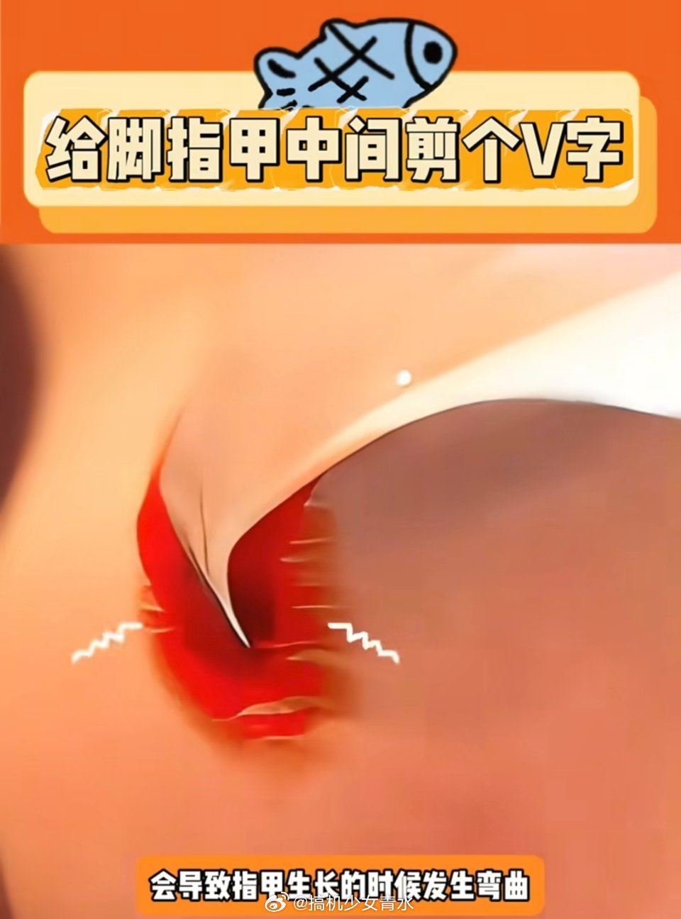 甲沟炎 剪v字没别的办法，让修脚师傅给你狠点减，减三四次就好了，而且第一次减从肉