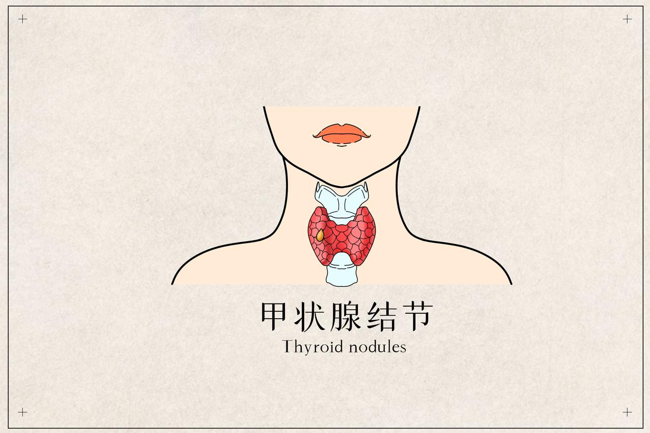#健康真探社#【查出甲状腺结节，离甲状腺癌还有多远？】甲状腺结节实际上是甲状腺内