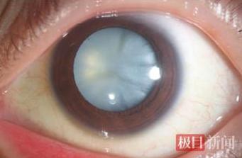 28 岁正当年，没人会把自己和 “失明” 两个字扯到一起。可 6 月底武汉刚发生