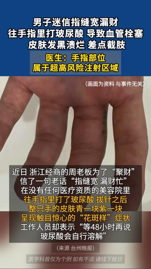 “封建迷信害死人！”近日，浙江，一男子迷信指缝宽漏财，就去了家美容院，给手指头打