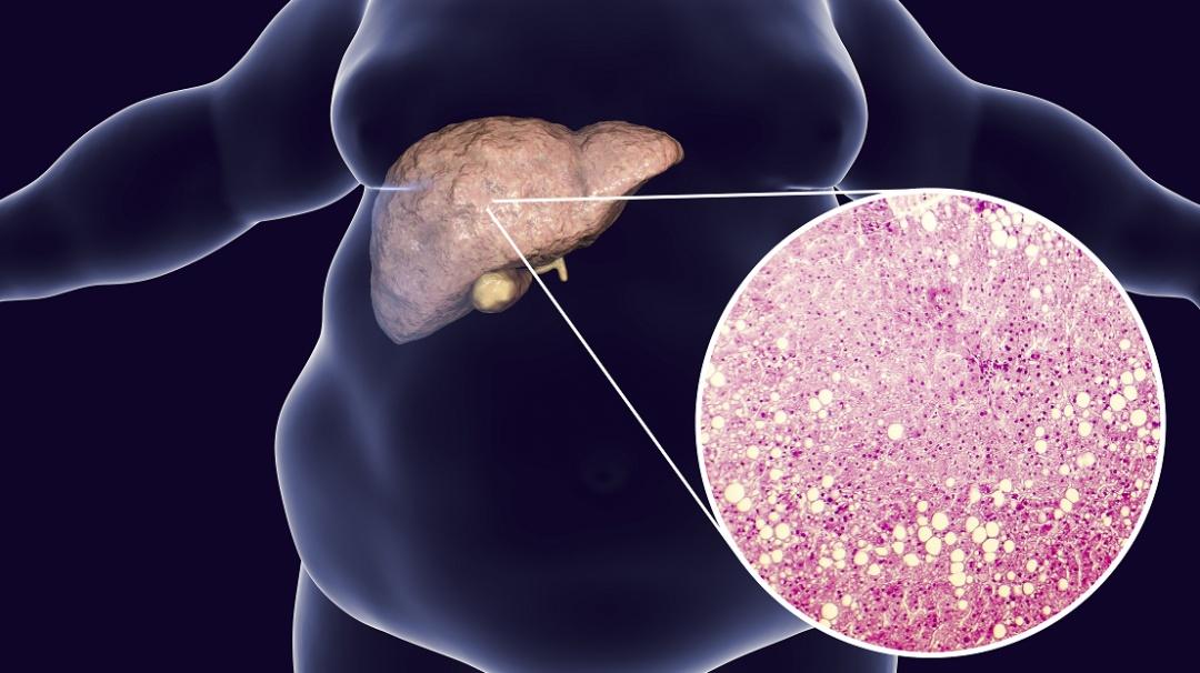 小区里坚持晨跑的大叔查出脂肪肝后愈发勤快，三个月后复查却未见好转，这让不少人疑惑