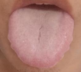 一、舌象辨证：跳出 “脾虚” 误区，认准 “肝火 + 湿热” 信号
消化、上火问