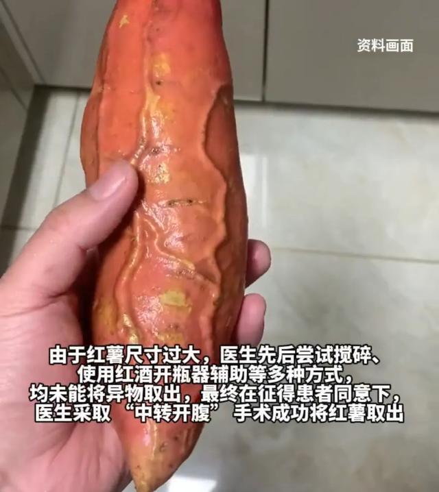 成都61岁男子肛门塞入17厘米红薯 开腹手术取出
 
近日，四川成都一名61岁男