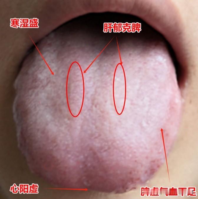 肝郁不是一般的重，连累到脾胃，还生了个寒湿，但这种千万别用逍遥、柴胡舒肝丸，根本