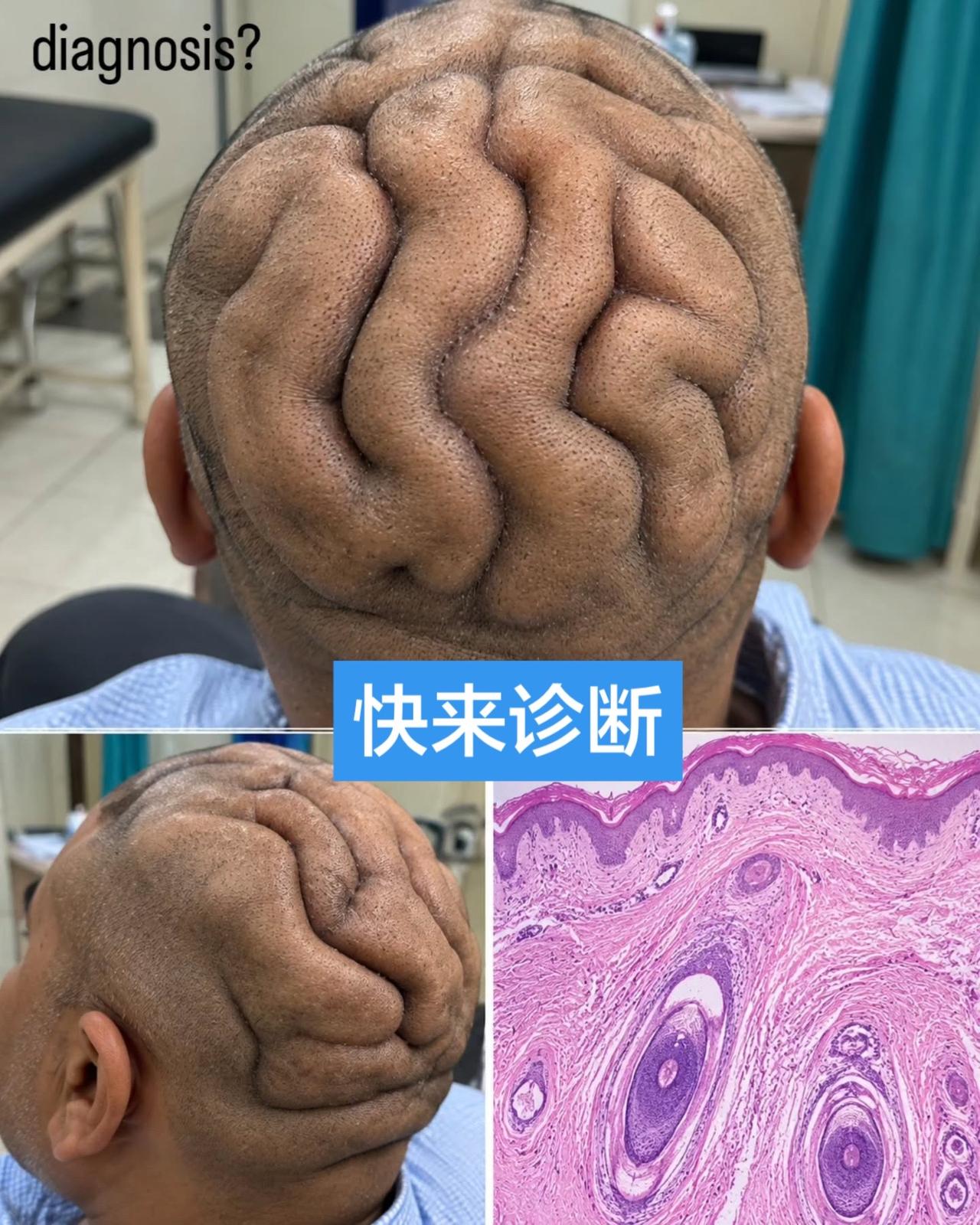 头皮像脑回一样，这是什么病？患者42岁，头皮长期、无症状、渐进性增厚；头顶及枕部