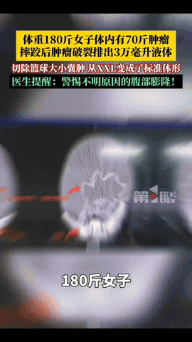 “离大谱！”浙江一女子减肥多年，180斤体重纹丝不动，没想到摔了一跤后，肚子突然