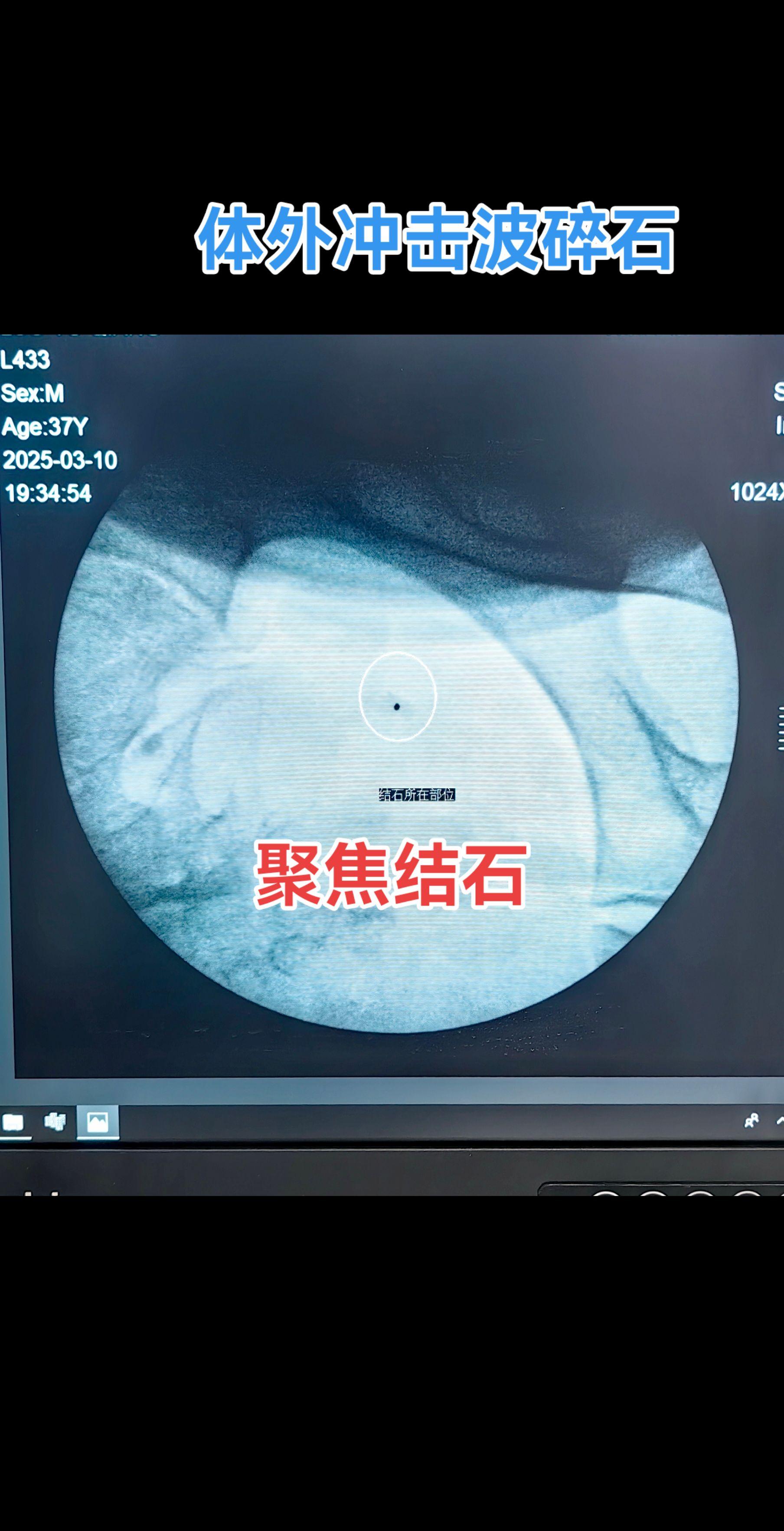 体外冲击波碎石