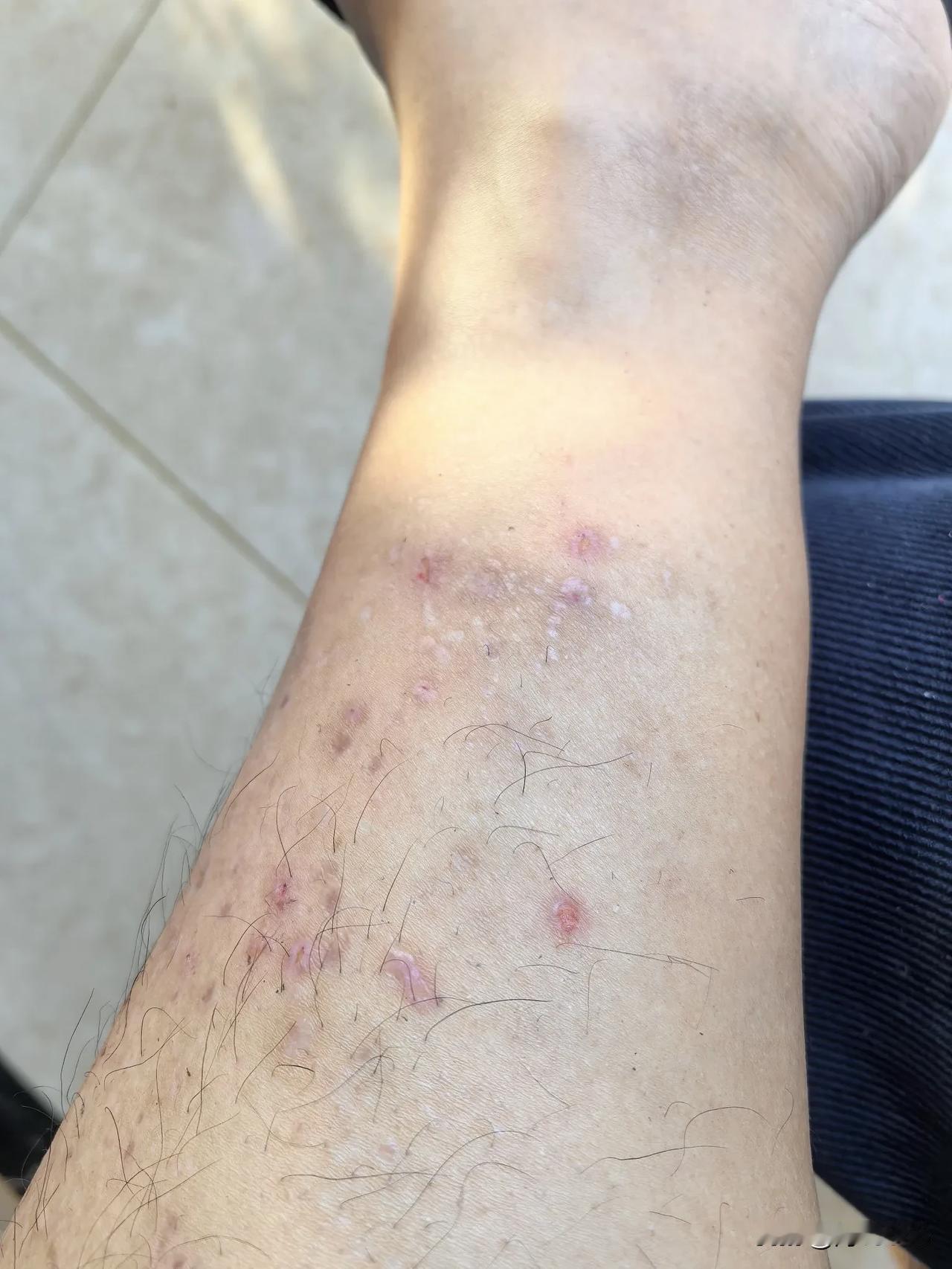 湿疹忌口真的很重要，春节期间，酒一口都没敢喝，海鲜，牛羊肉一口都没敢吃，基本上就