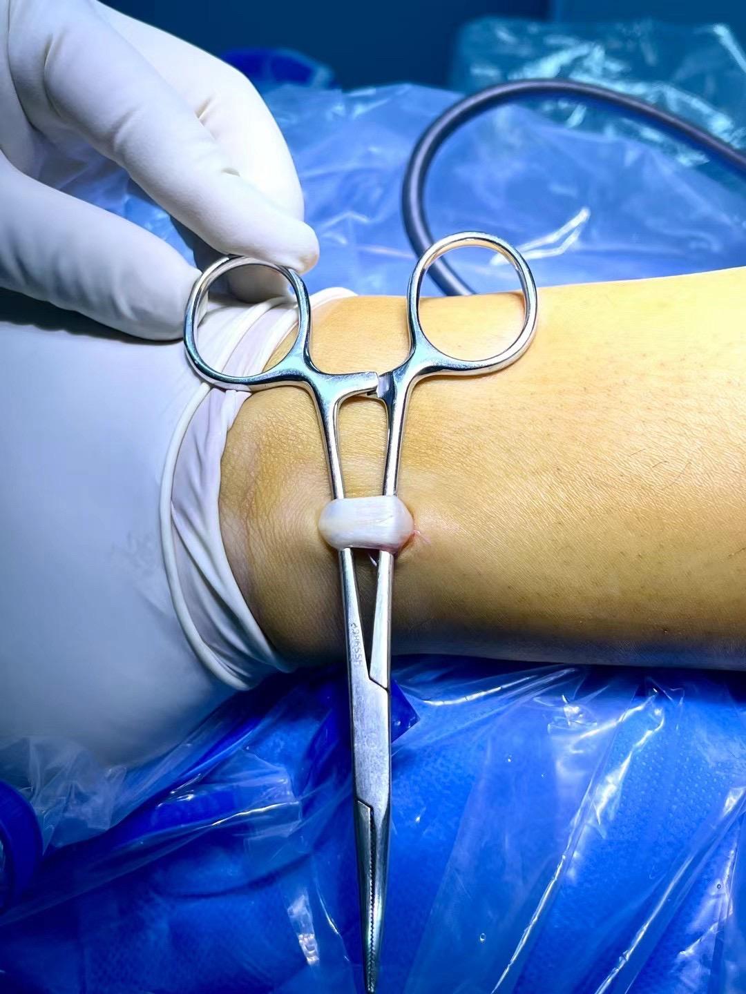 腓骨长肌腱如何取腱？用于交叉韧带重建