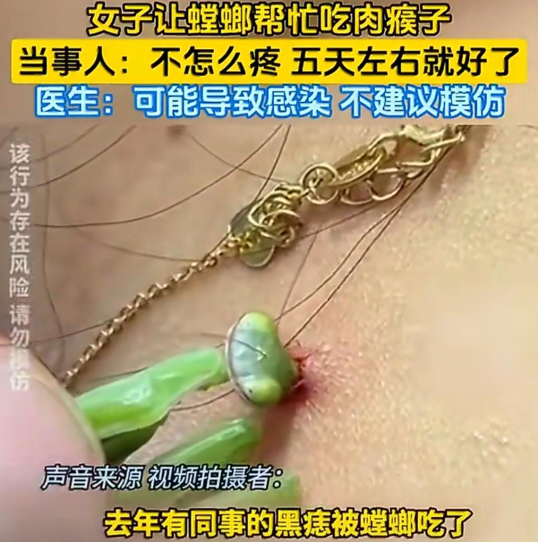 女子让螳螂“咬掉”自己脖子上的肉瘊子，医生急了！这事真的千万别模仿学啊！
 
最