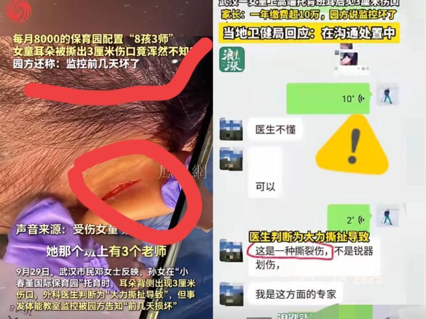 气炸了！
10万一年的高端托育，
把两岁半娃耳朵撕出3公分大口子，老师竟说“是汗