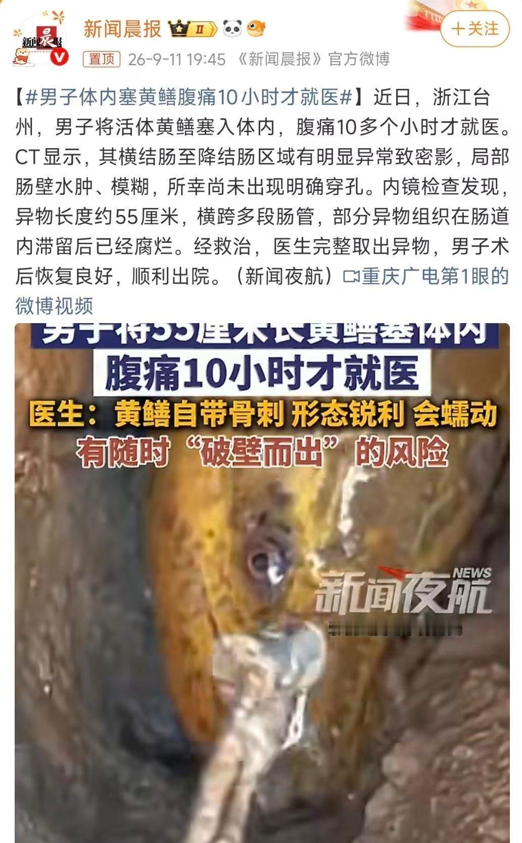 浙江台州一男子将活体黄鳝塞入肛门，强忍腹痛10多个小时才就医，医生最终通过内镜从