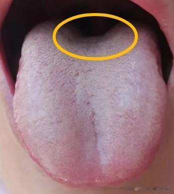 舌根就是男人的命根，舌根凹陷到这种程度，毫无能力可言。

患者主诉：宗筋难起，卸