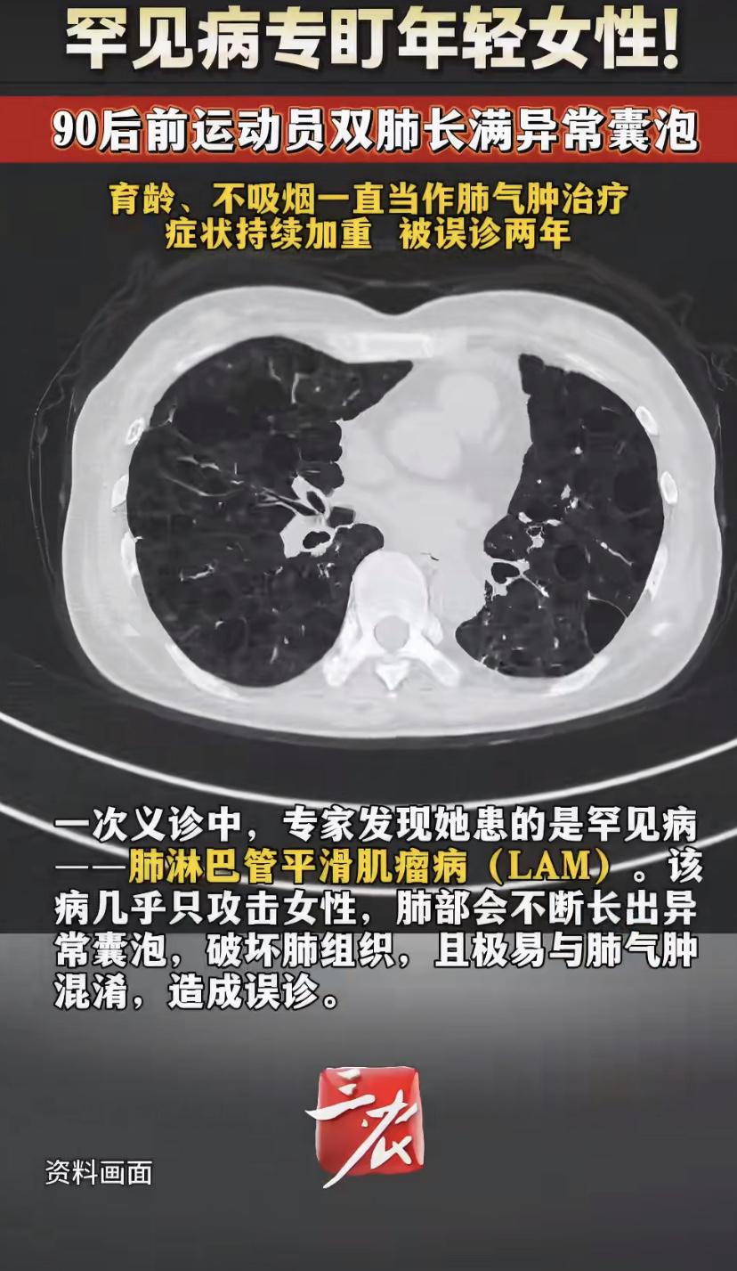 90后前运动员跑几步就喘，两年都按肺气肿治，结果真相让人意外
福建一位90后姑娘