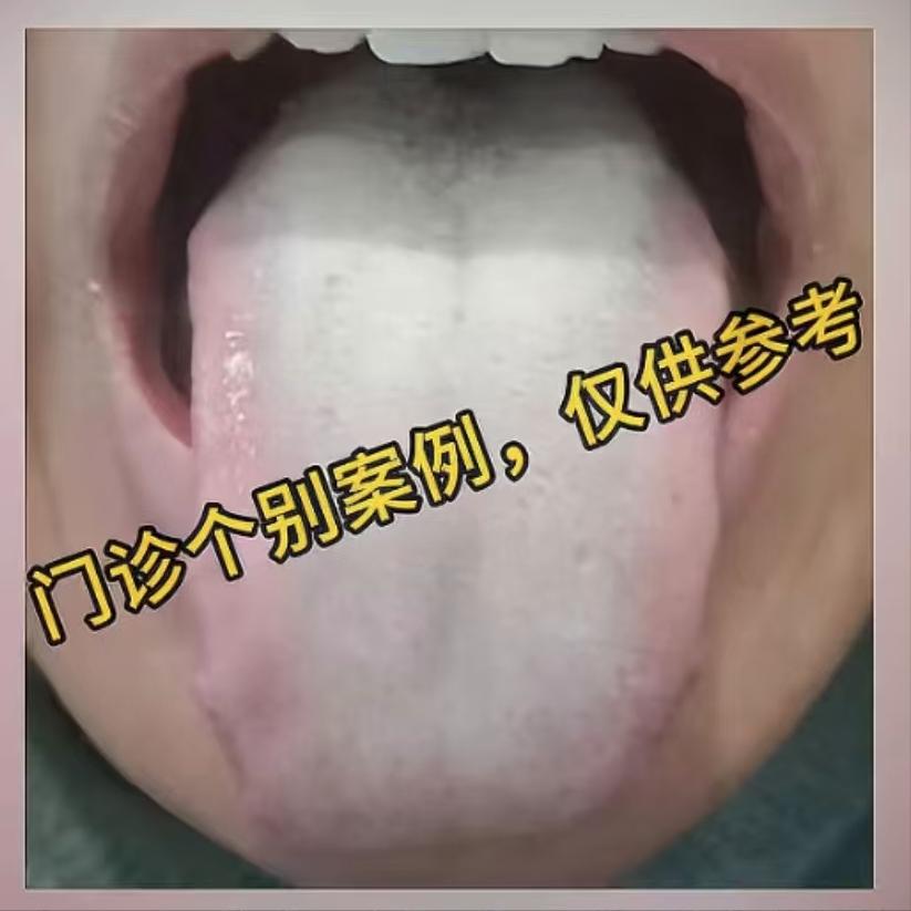 这种白腻苔，附子理中丸就是隔靴搔痒，两个药把舌苔刮干净

整个舌头都被白腻苔铺满