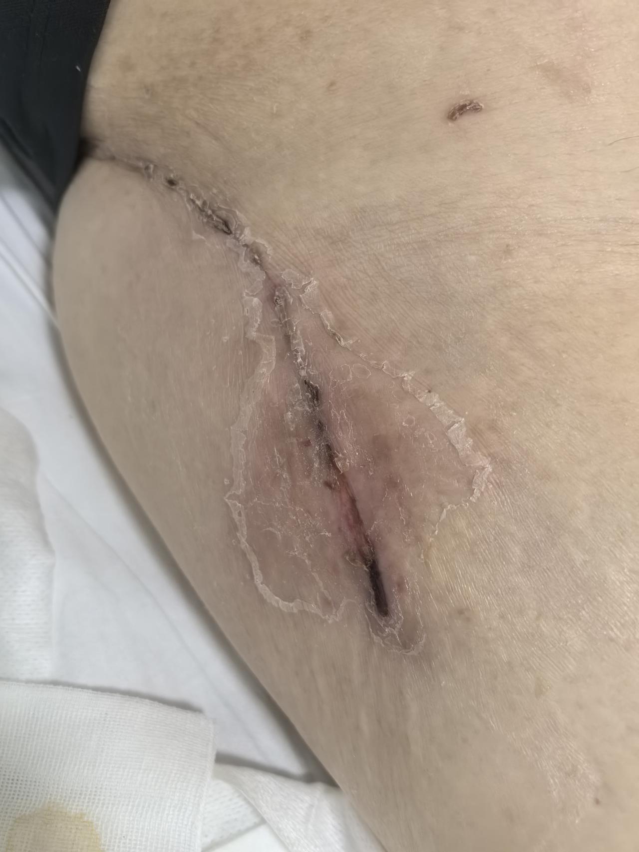 这是我爸髋关节翻修术后，因为提前回家引发的感染返回医院的第四天，换药的时候，渗出