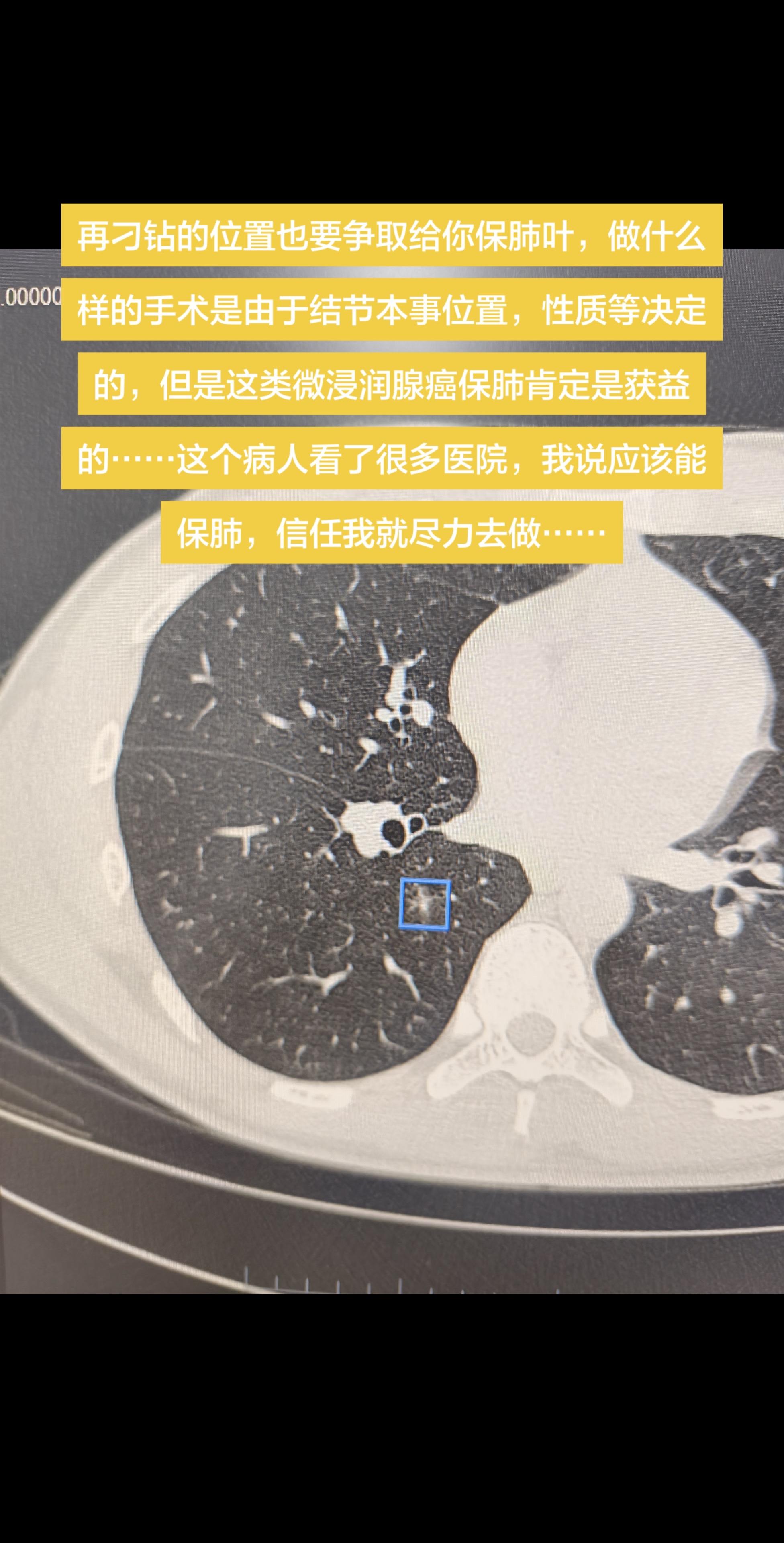 微浸润癌结节位置不好？尽力就好…… 再刁钻的位置也要争取给你保肺叶，做...