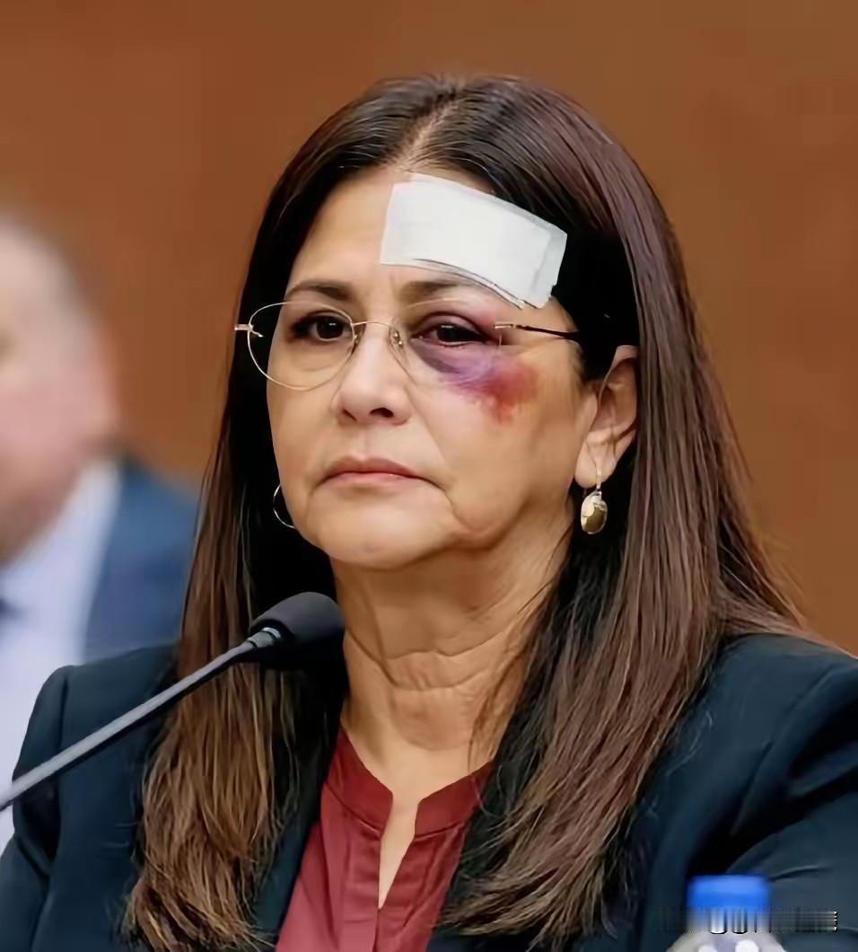 欲戴王冠必承其重：委内瑞拉总统夫人伤疤背后的权力阴影

  那道伤疤像刀锋划过精