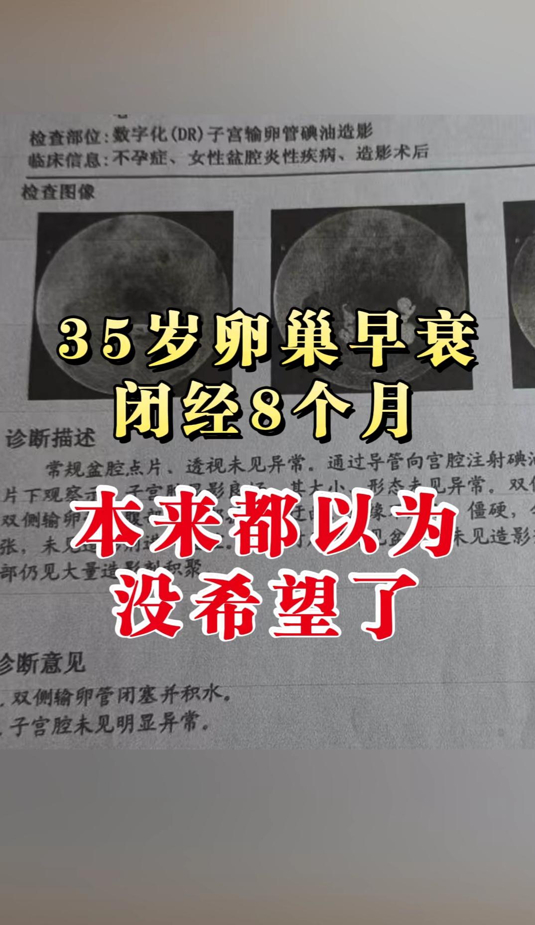 35岁李女士，因闭经8个月就诊，确诊卵巢早衰。 性激素六项提示：FSH...