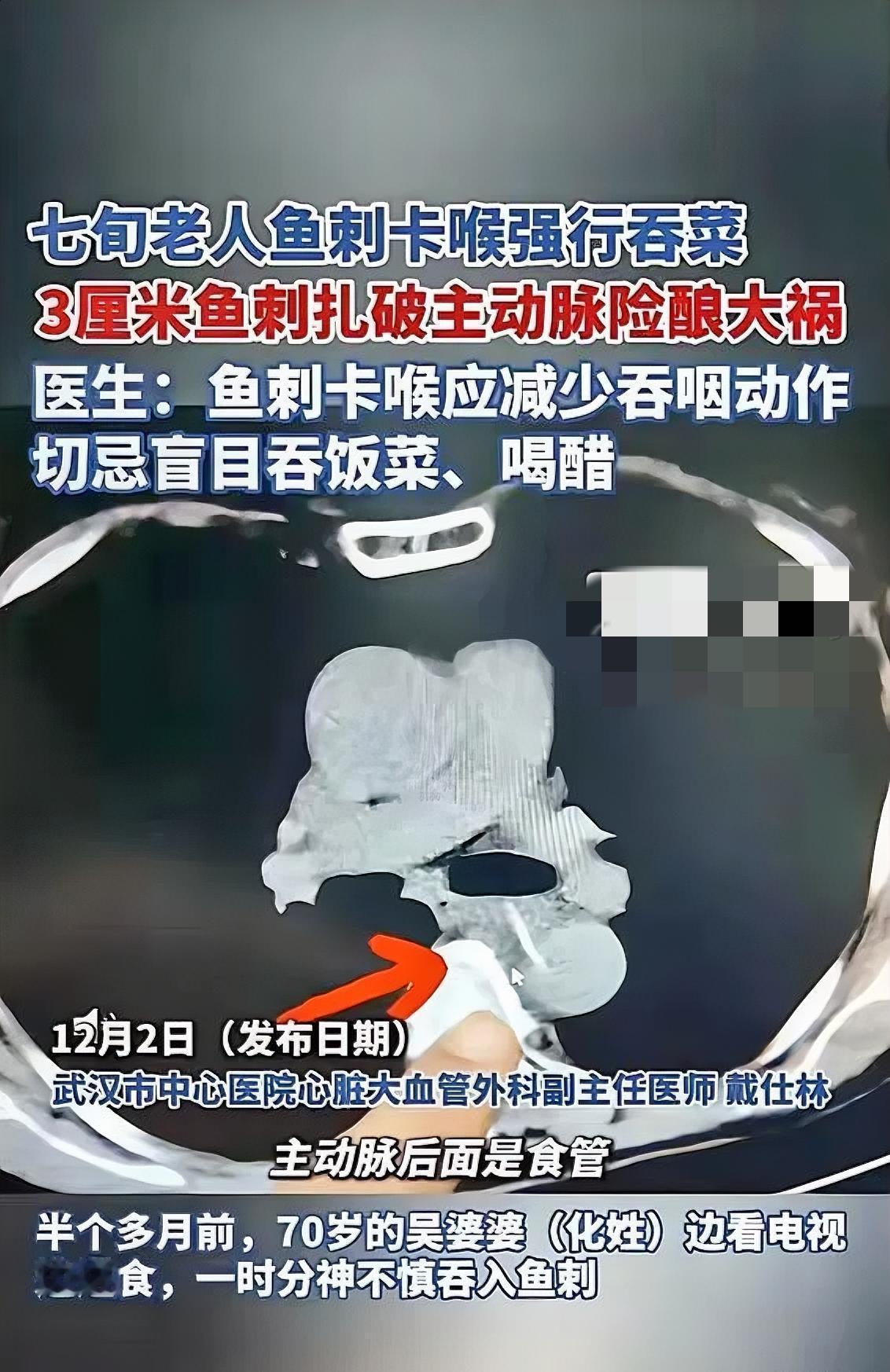 “这下后悔了吧！”近日，湖北武汉，一老太边看电视边吃鱼，不慎吞入鱼刺，于是连忙吞