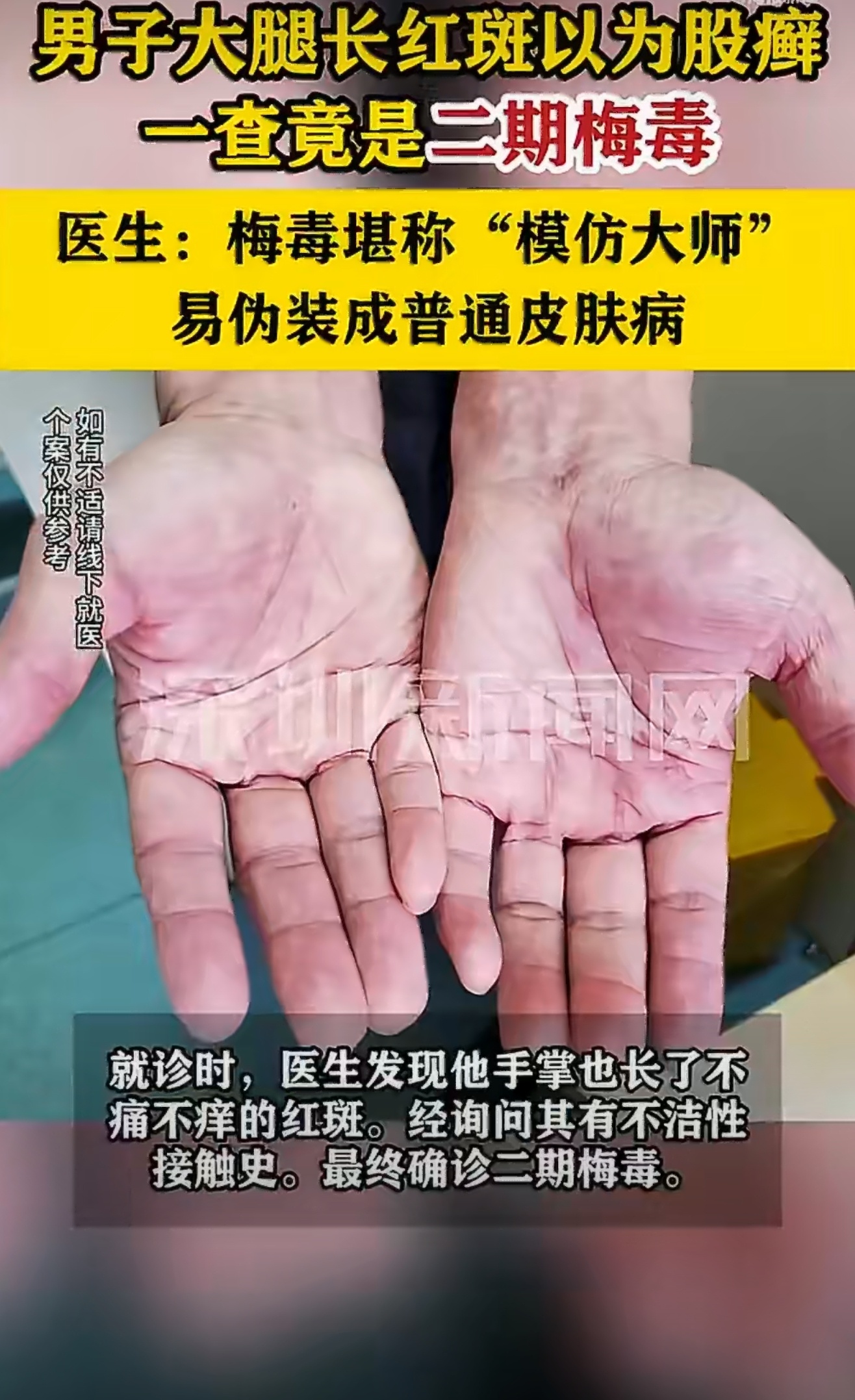 梅毒堪称皮肤科头号“影帝”，红斑、皮疹、溃疡样样能装，从股癣到湿疹骗倒无数患者，