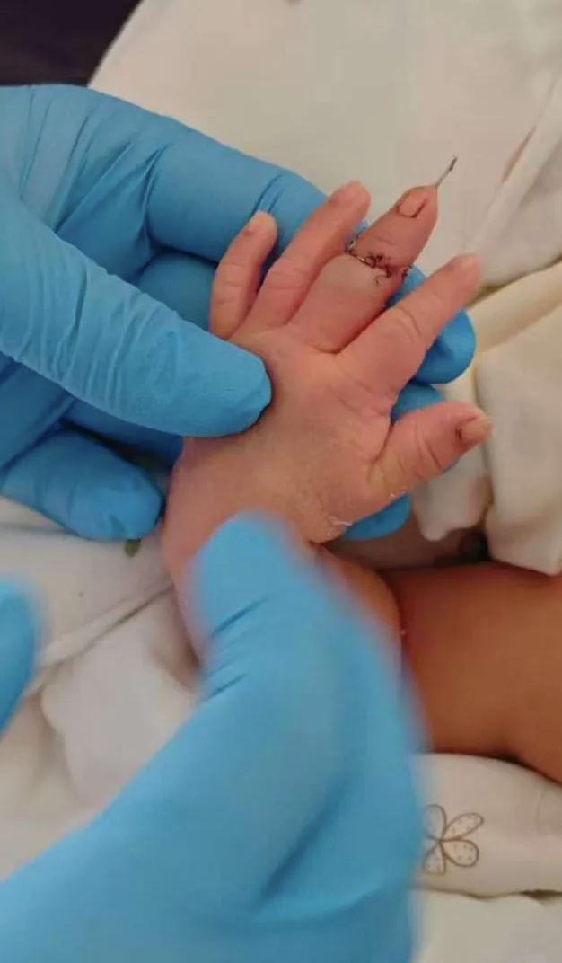 痛心！新生儿剖宫产剪脐带被剪断手指，助产士称“孩子乱动”，家属申请医疗事故鉴定讨