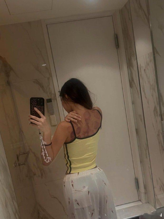 小S大女儿晒拔火罐背部 小S大女儿晒拔火罐背部，好养生啊！小S大女儿晒针灸拔罐日