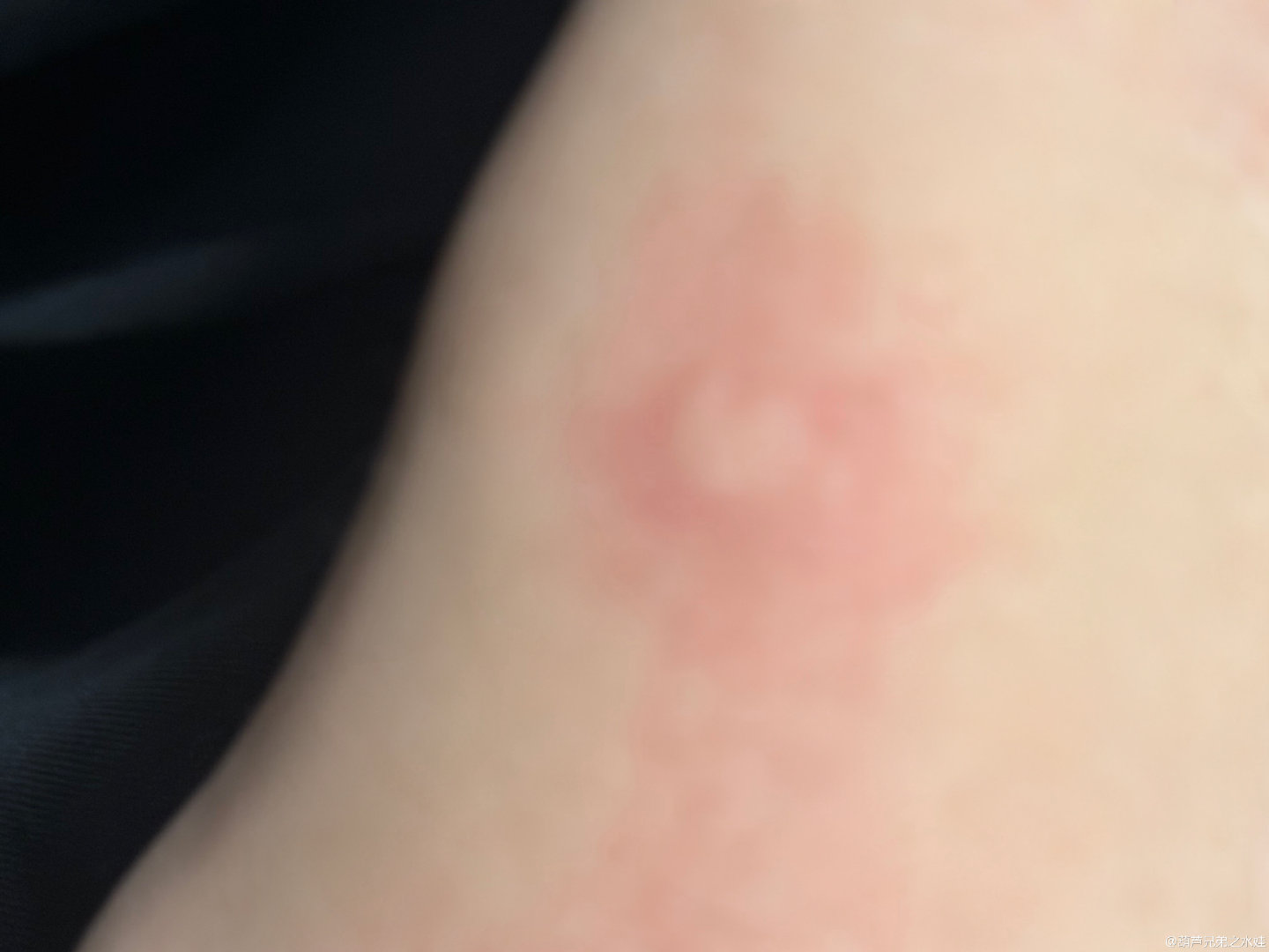 左奇函蚊子包都是爱你的形状左奇函被蚊子咬了个爱心包 啊哈哈哈哈哈 