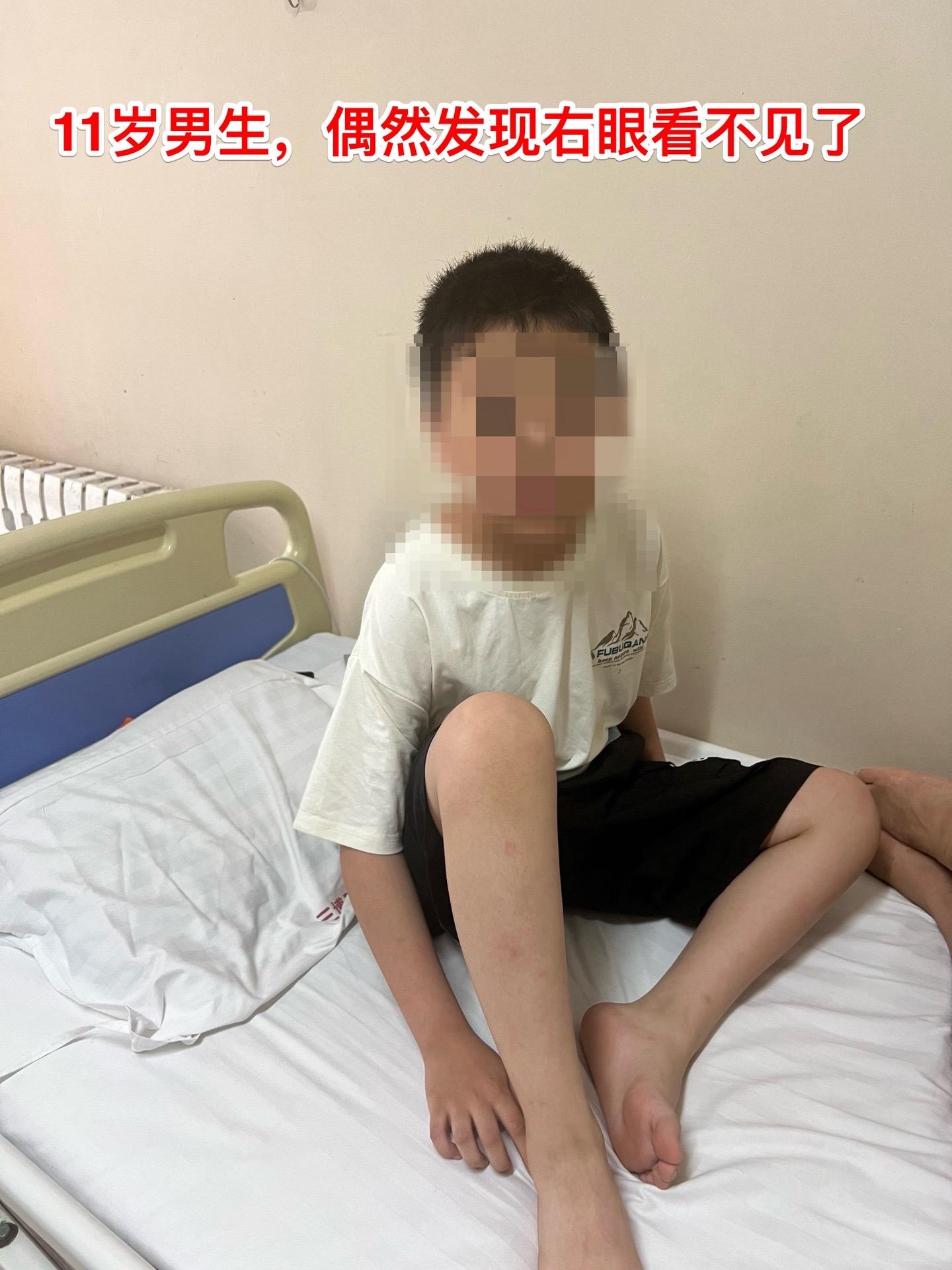 鞍区皮样囊肿比颅咽管瘤更罕见。11岁的湖北男孩子在学校体检查视力发现右眼几乎失明了，看不见东西，只有光感！
        而他自己却不知道！平时也没有感到头痛，没有太多的不适。这个孩子是多粗心呀！
         随后行脑部CT和磁共振检查发现鞍区
有个肿瘤，怀疑为颅咽管瘤。CT显示肿瘤没有钙化，这一点不符合颅咽管瘤。  
        5月31日作了开颅手术，将病灶完全切除。病灶的囊皮是灰色的，内部有油脂样的粘滞物，还含有毛发。所以术中诊断为皮样囊肿。这是近10年以来的第三例鞍区皮样囊肿手术。前两例