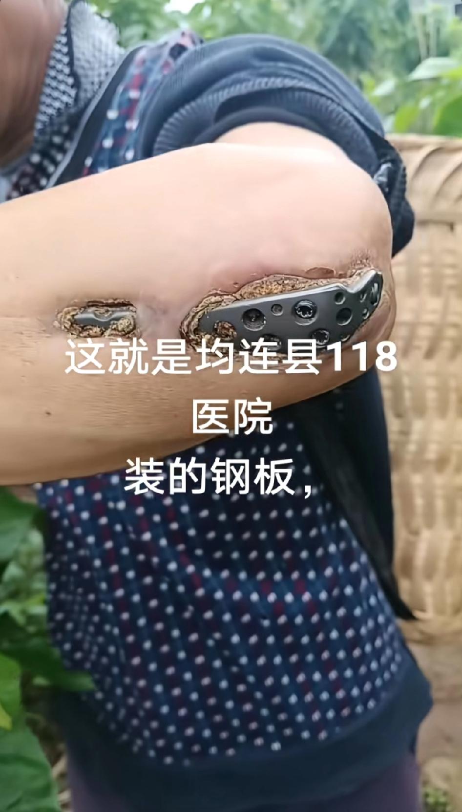 这竟然是医院安装的钢板，直接整成终结者了，白细胞：遇到你，是我这辈子干过最重的活