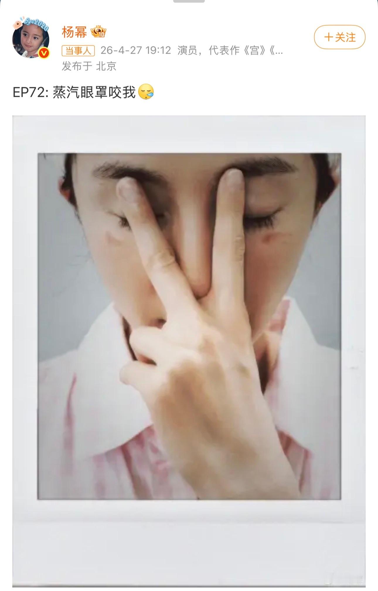 这么明显的红印，心疼杨幂，也给所有人敲响警钟。杨幂脸被蒸汽眼罩烫伤了