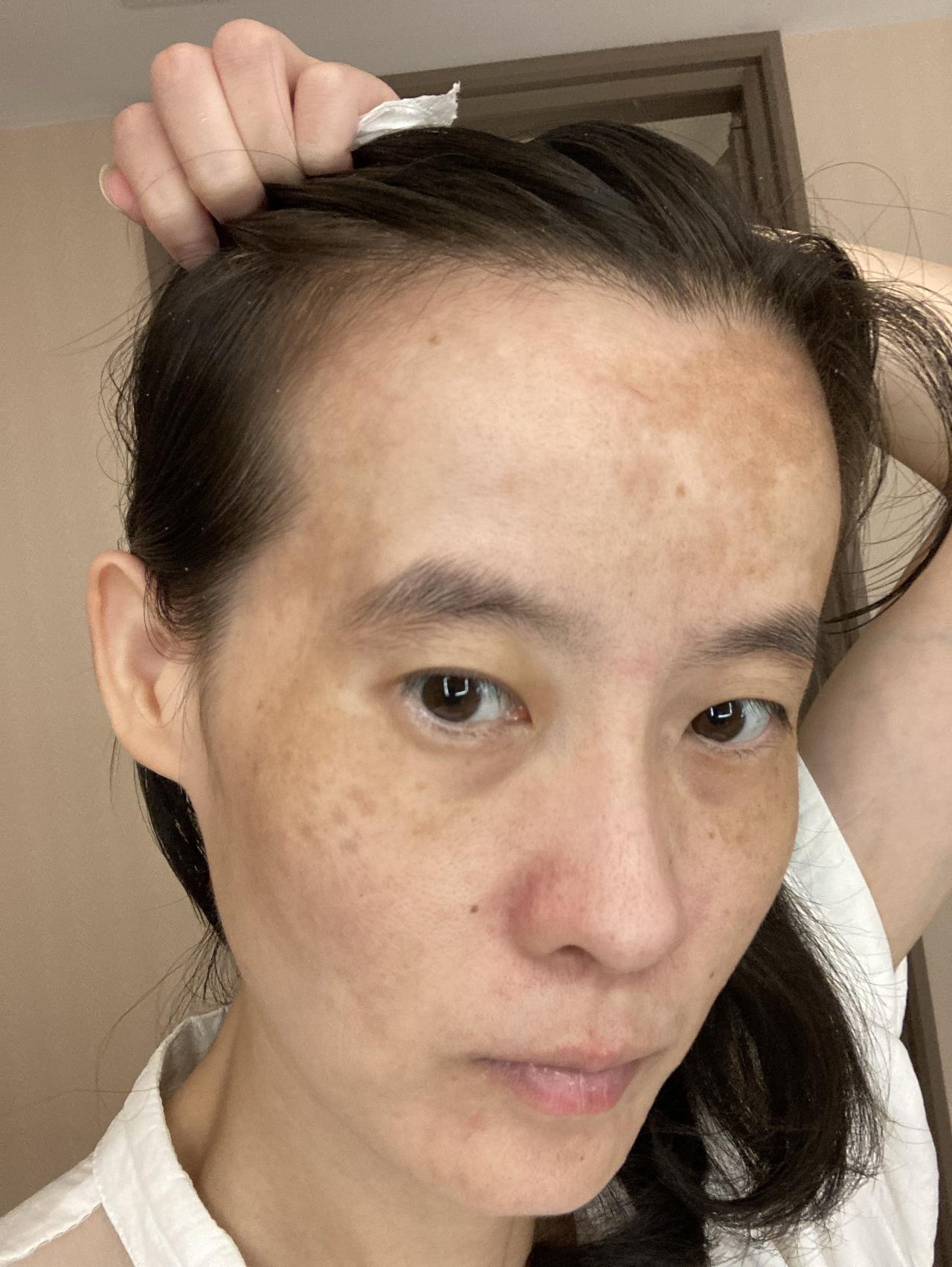 没稳定下来，看病都无法去看，我很着急去看皮肤[流泪][流泪][流泪]每天又困又累