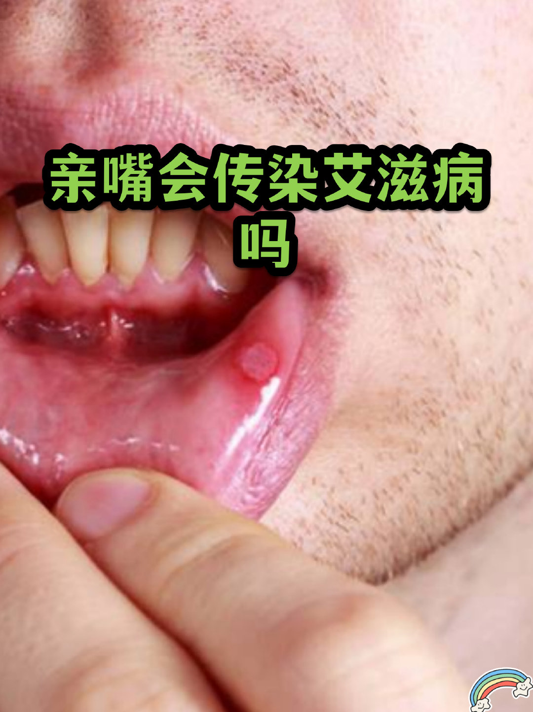 接吻会不会传播艾滋病？答案很明确：不会。据认证媒体报道，虽然唾液里也含有HIV病