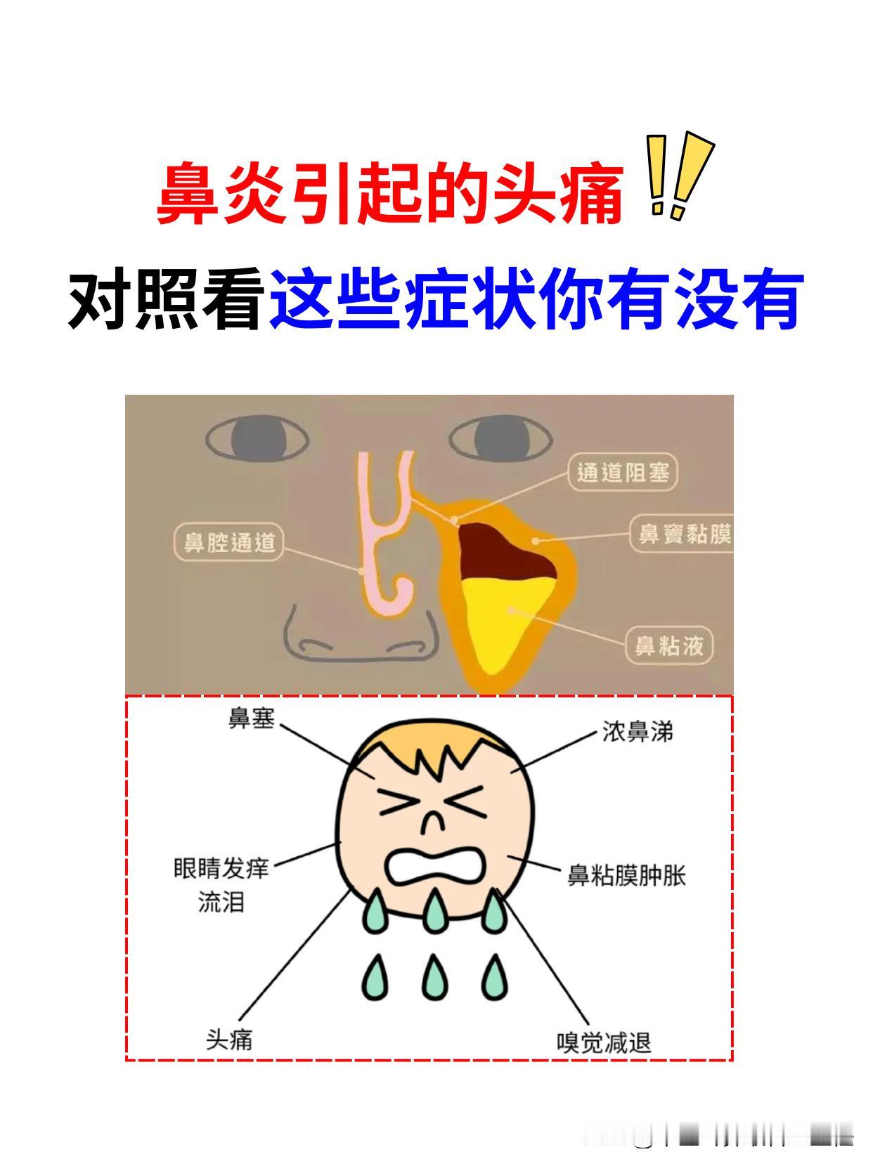 反复头痛，竟是鼻子惹的祸！快对照看这些症状你有没有！
 
来到门诊上很多鼻炎都会