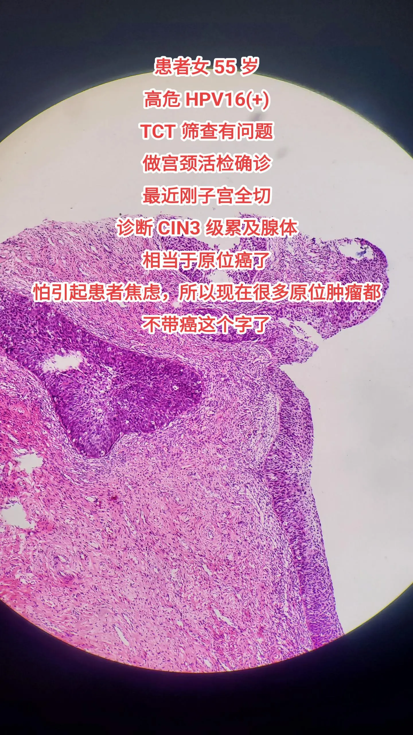 hpv感染  宫颈cin3级
