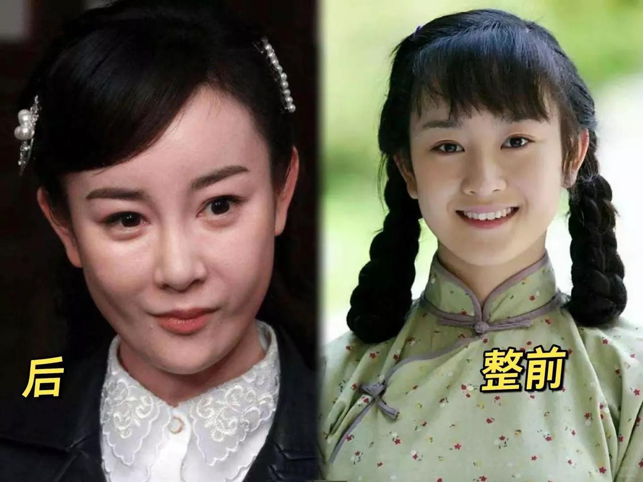 张檬整前后对比。
整后毁了事业。
因插足刘雨欣婚姻，备孕一直没成功！