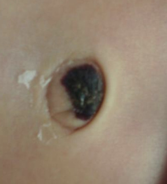 宝宝出生后，医务人员会将脐带结扎，切断。断脐后，脐带残端会逐渐干枯变细，慢慢变为