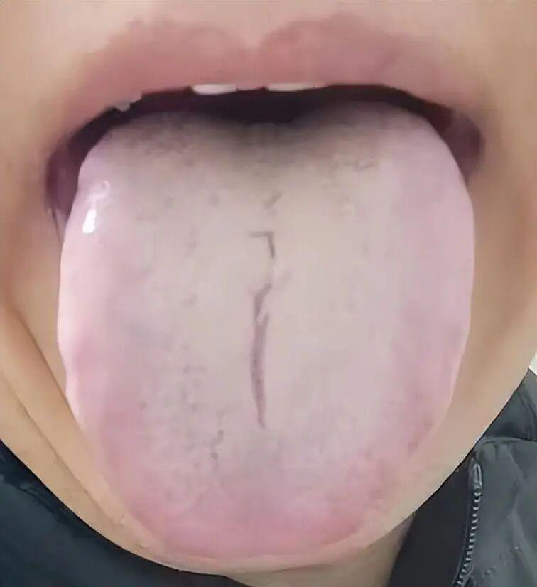 舌苔厚腻、四肢沉重，揭秘脾虚痰湿真相
粉丝反映说，他遭遇了脾虚痰湿重的困扰，表现