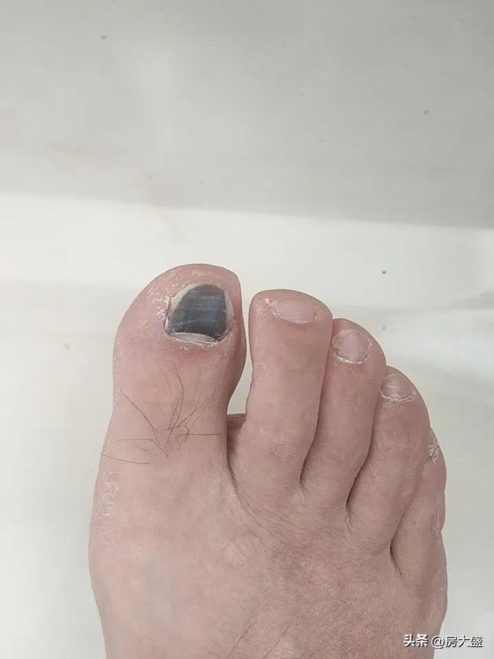 不太能直接判断你脚趾咋回事呢。要是脚趾上有黑点，可能是普通的色素痣、跖疣，也可能