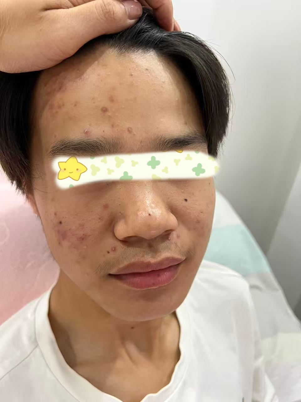 用了一段时间的玉肌散和紫草膏，脸上的闭口粉刺、痘痘少了很多。 ​​​
