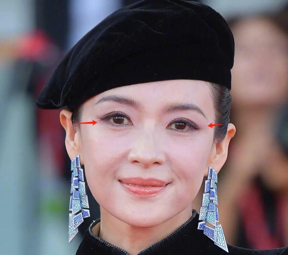 44岁的章子怡，红毯生图一出，网上瞬间炸开了锅。有人说她“脸肿得像发面馒头”，医