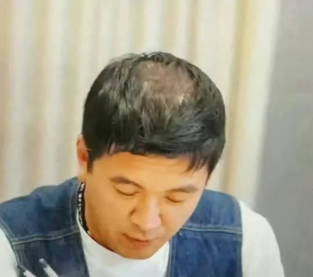 杨子这已经秃顶了吗？ 