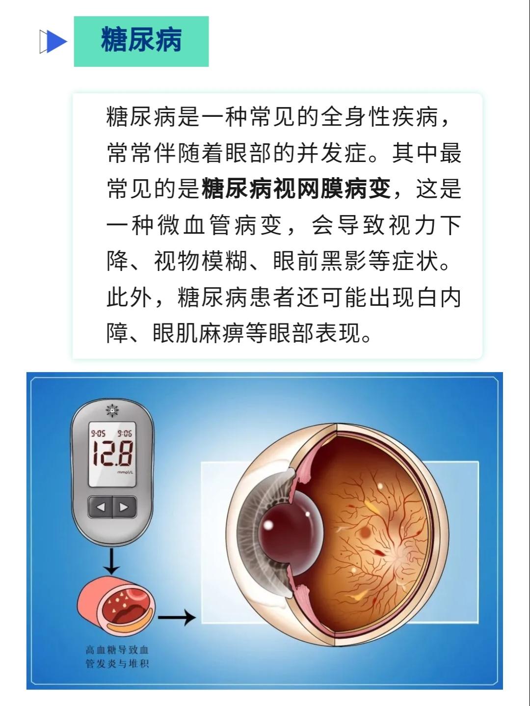 眼部是人体的重要器官，它在许多内科疾病中发挥着重要的预警作用。通过对眼部表现的观察，可以获得关于全身健康状况的线索，有利于更早地发现内科疾病的发展与变化。同时，患有全身基础疾病、慢性病的患者在日常生活中应关注自己的眼部表现，一旦出现异常症状，应尽早就医、尽早采取有效的治疗措施。