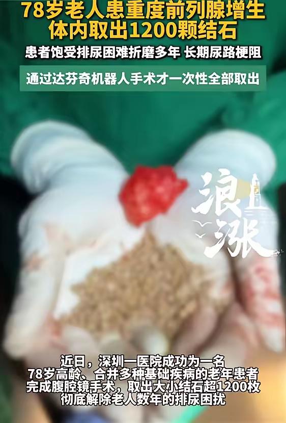“简直目瞪口呆！”7月30日报道，广东深圳，一78岁大爷排尿困难，被折磨多年，造