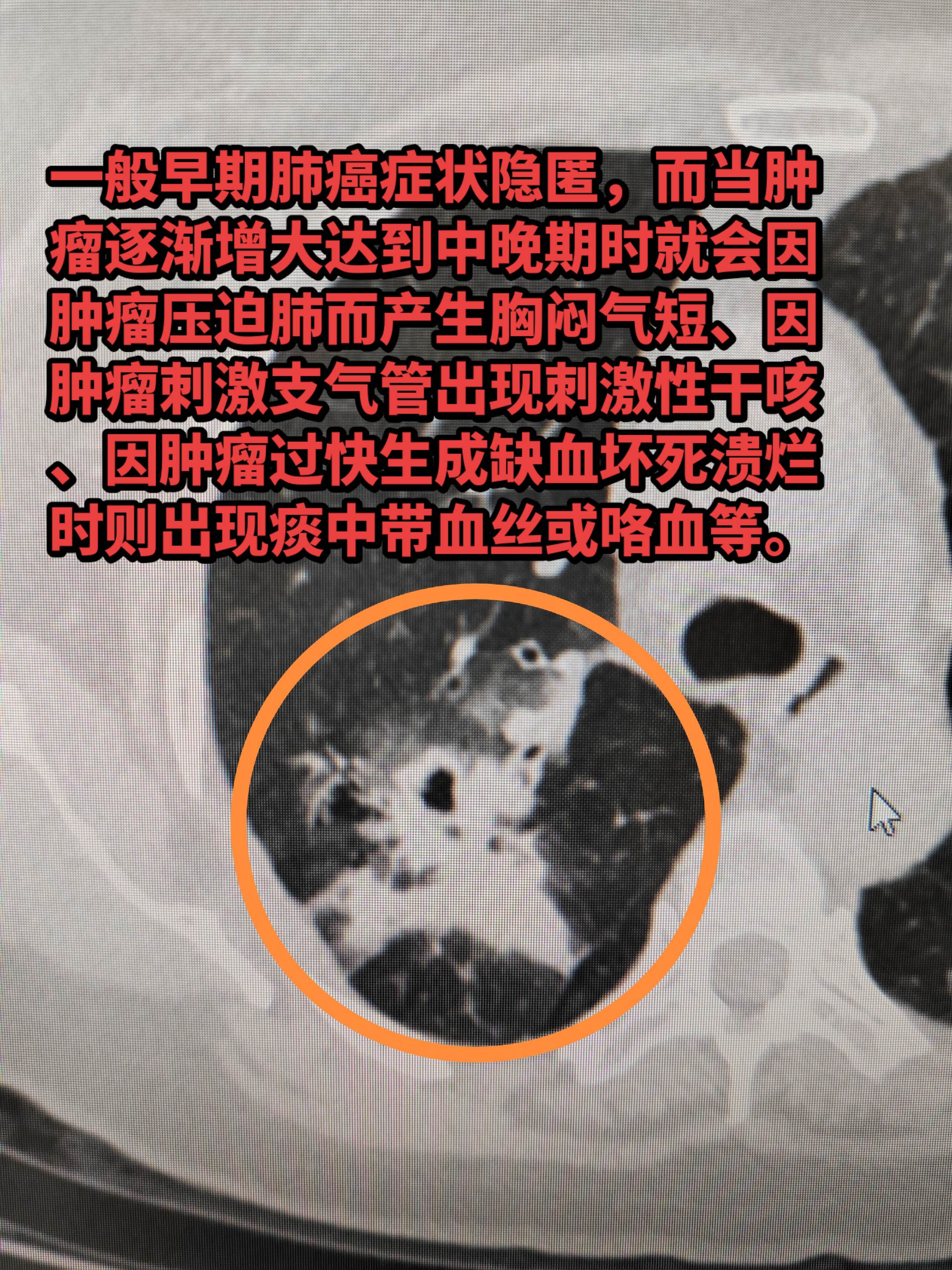 刺激性干咳、胸闷、痰中带血丝，警惕肺癌！一般早期肺癌症状隐匿，而当肿瘤...