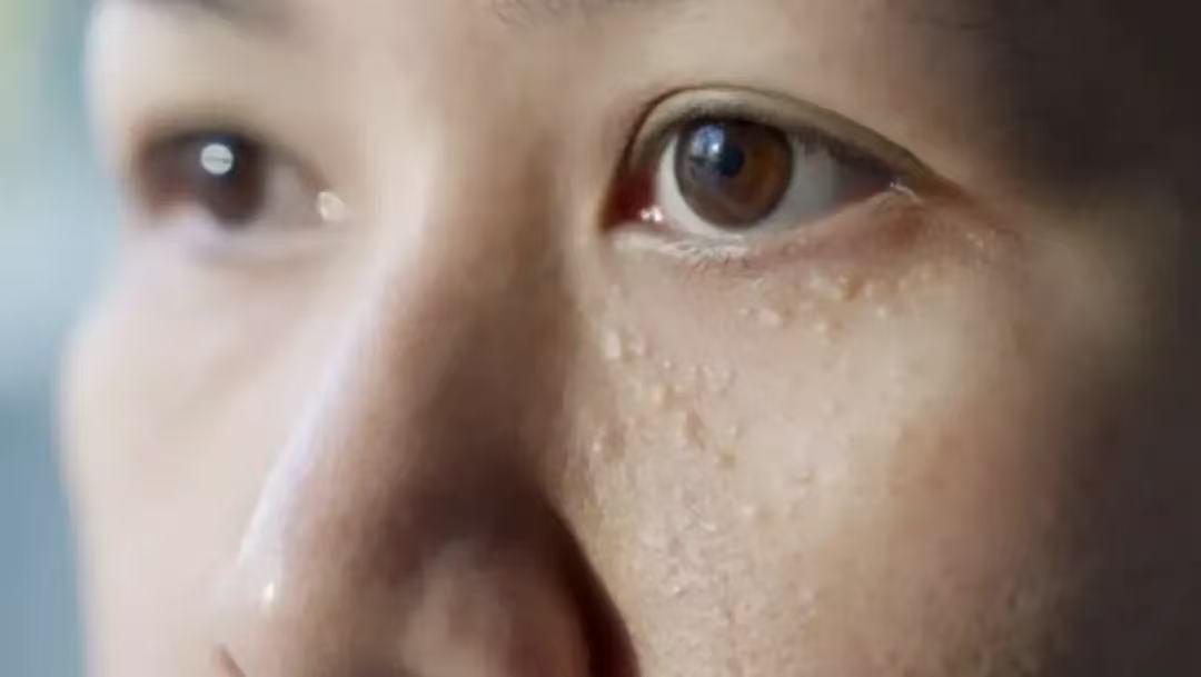 眼睛周围长的小颗粒到底是什么？
 
照镜子时突然发现眼周冒出几颗小颗粒，不红不肿
