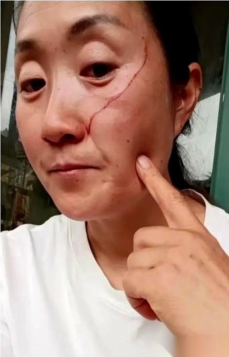 湖南株洲那位高考陪读的刘阿姨，把女儿抓伤自己脸的视频，发到了网上。
镜头前，她指